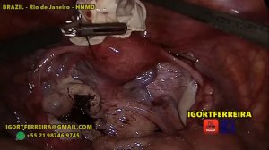 Cirurgia de Cisto de Ovário de 8cm por Laparoscopia Comentada - FullHD 60Fps