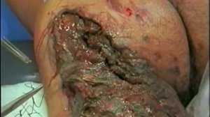 Военно полевая хирургия  учебный фильм