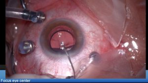 Post myopic PRK eye, LENTIS Comfort EDOF , macular hole Lukan Mishev Live Stream