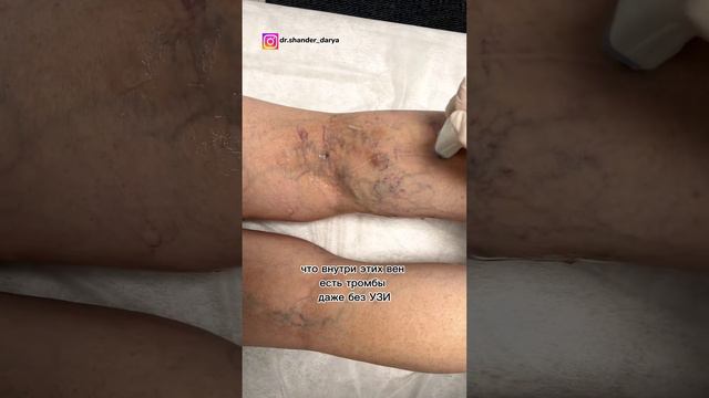 Тромбы в венах ног