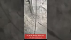 Заміна аортального клапана TAVI