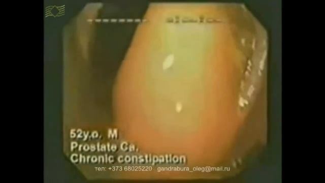 Кишечник - глубокая очистка смотреть онлайн