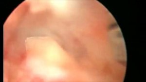 Гистероскопия, удаление фрагмента ВМС при неполной перфорации матки