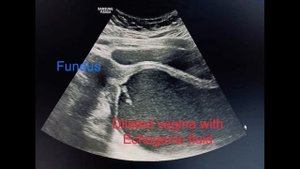 Classic case of imperforate hymen with hematocolpos