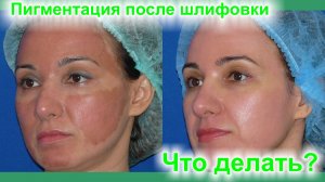 Пигментация после лазерной шлифовки.