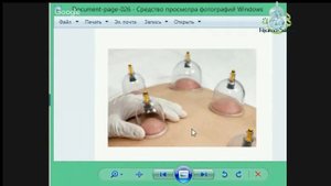 Должен ли оставаться синяк после хиджамы?