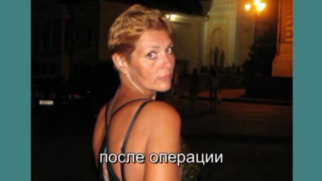 Желудочное шунтирование - история преображения.