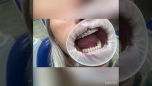 Обработка зубов под коронки и установка коронок