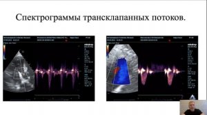 Допплерографическая оценка трансклапанных потоков