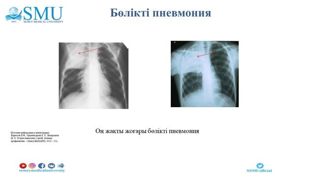 Балалар жедел пневмониясының диагностикалық белгілері және емі смотреть онлайн