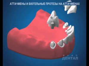 Бюгель на аттачменах