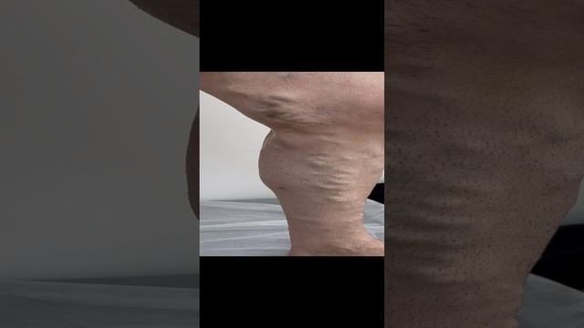 Варикоз на ноге у парня. Как лечить варикоз? Записаться на прием к флебологу по вацап 89250423646 смотреть онлайн