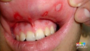 Лечусь по интернету: стоматит. Жить здорово! Фрагмент выпуска от 17.01.2020