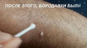 Как удалить бородавки (замедленное видео)