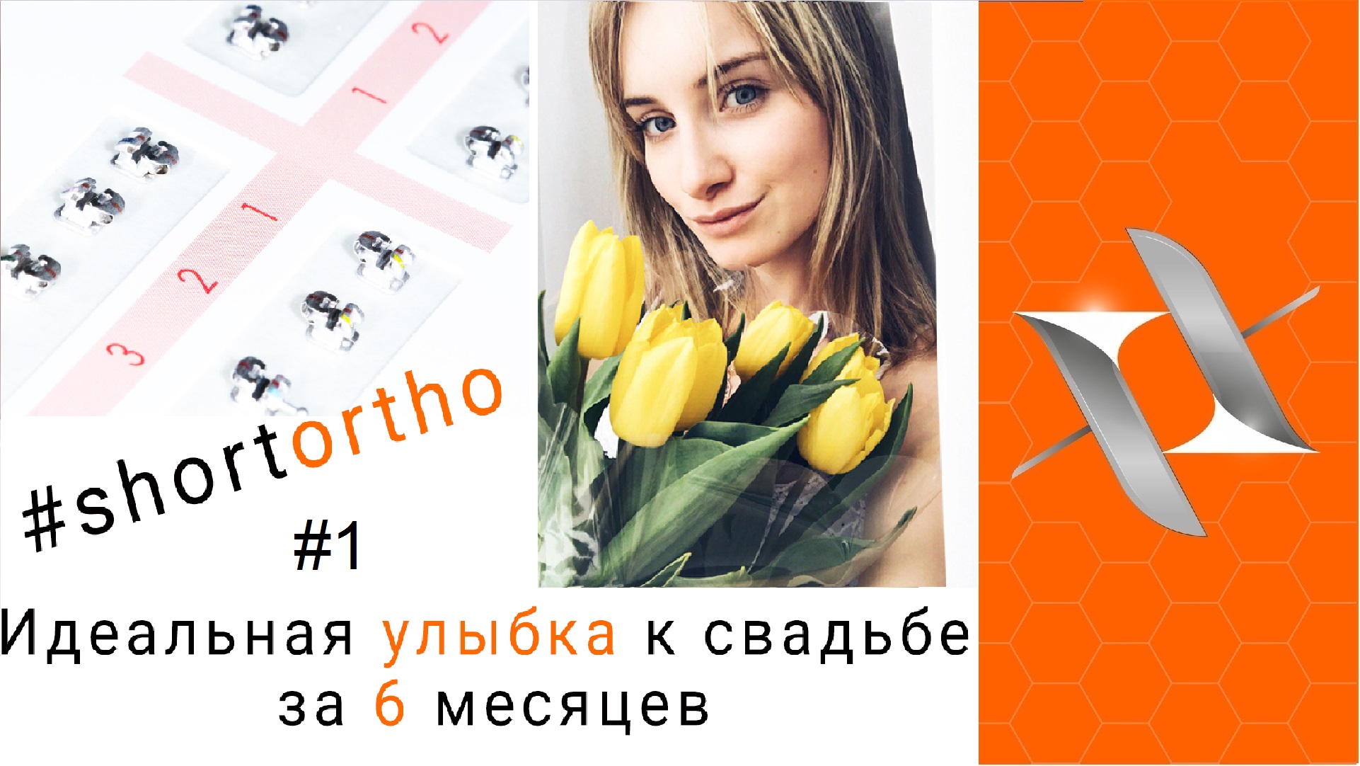 Идеальная улыбка к свадьбе за 6 месяцев. Ортодонтия и брекеты. #Shortortho №1.