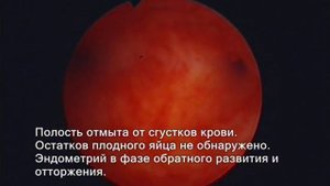 Полный самопроизвольный выкидыш