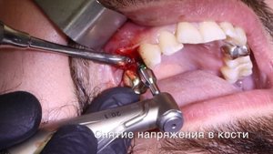 Установка дентального имплантата Южно Корейского производства Osstem.