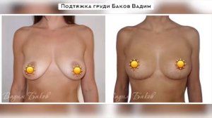Результаты подтяжки груди
