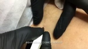 Удаление папиллом!