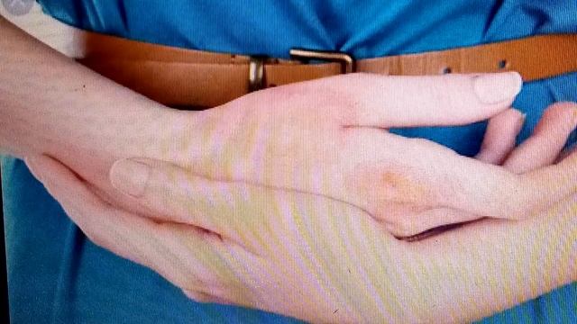 ДЕЙСТВЕННЫЙ РЕЦЕПТ ОТ ОЖОГА И ОТ РУБЦОВ 14.12.2019 смотреть онлайн