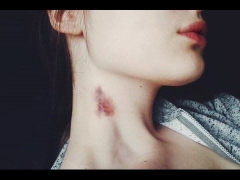 КАК БЫСТРО Избавиться от ЗАСОСА/СИНЯКА?✔Elena Matveeva