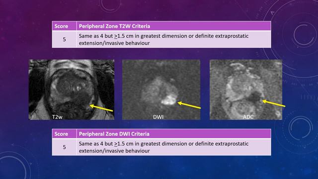 Introduction to PI-RADS смотреть онлайн