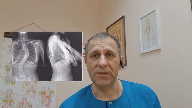Чем опасен сколиоз? смотреть онлайн