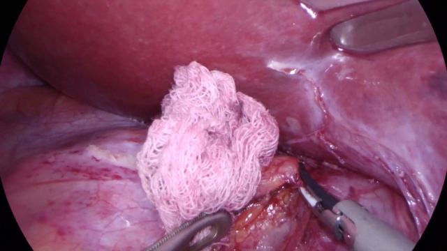 Кровотечение из притоков полой вены смотреть онлайн