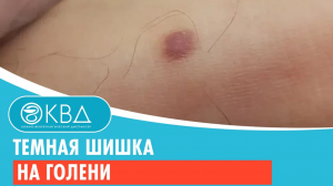 Темная шишка на голени. Клинический случай №792