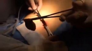 Однопрокольная холецистэктомия