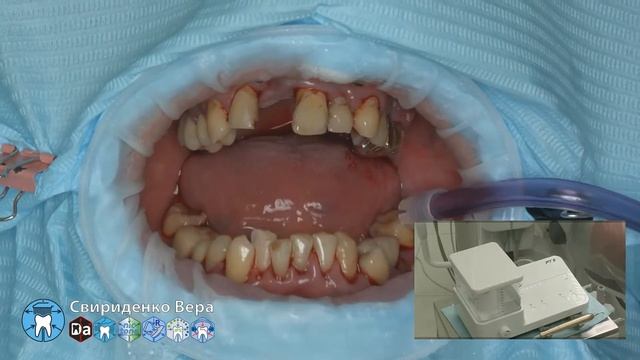 Professional oral hygiene -case 008 Acteon DTE Dentsply Coxo Floweis 3M KerrHawe (FHD multistream)