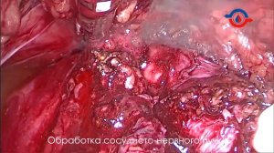 Удаление предстательной железы больших размеров, стентирование с 2-х сторон мочевыводящих путей.