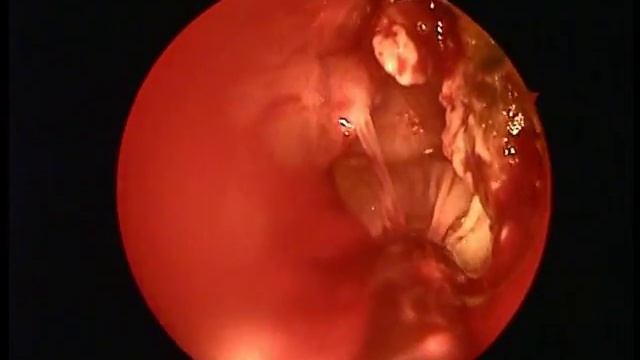 эндоскопическое удаление грибкового тела из верхнечелюстной пазухи смотреть онлайн