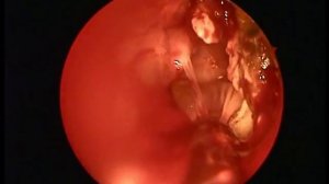 эндоскопическое удаление грибкового тела из верхнечелюстной пазухи