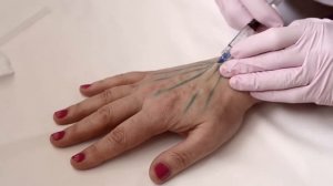 Филлеры для рук