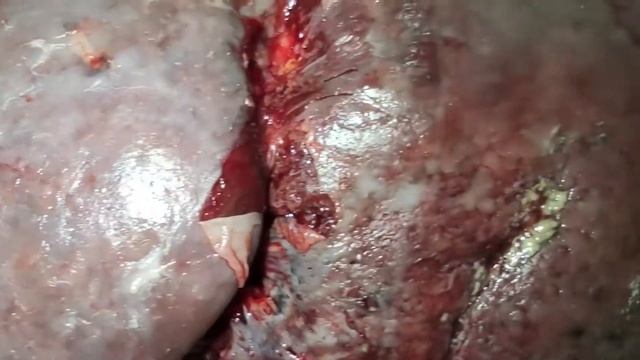 Спленомегалия. Увеличение селезенки при циррозе печени.