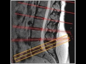 L spine MRI positioning