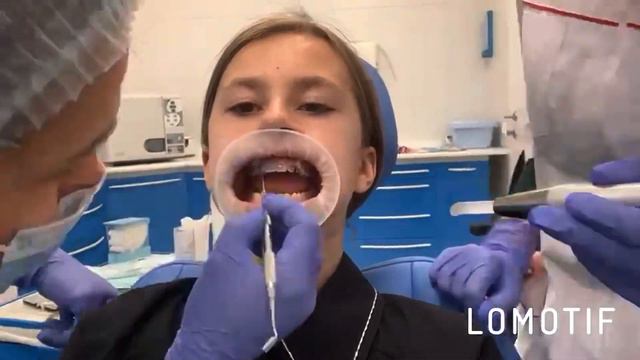 Ставим брекеты для ровных зубок смотреть онлайн