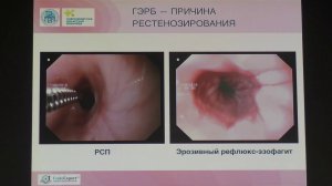 24 Аникина МС Эндоскопическое бужирование доброкачественных стенозов пищевода у детей