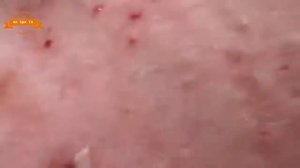 Удаление прыщей с носа и щек Spa G #067