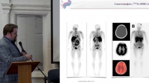 Пузакин Е.В. Сравнительные аспекты лучевой диагностики поражений скелета при множественной миеломе.