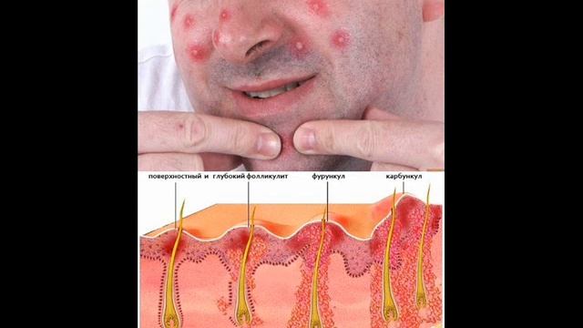 Обучающее видео. Карбункул смотреть онлайн