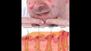 Обучающее видео. Карбункул