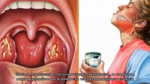 Ангина - чем мазать горло?