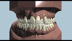 Перекрестный прикус зубов  Лечение каппами Star Smile