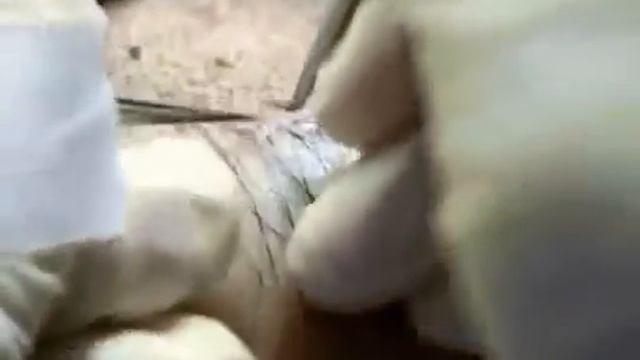 Пересадка длинных волос - Hairline International смотреть онлайн