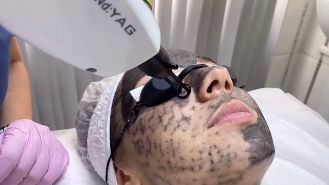 Карбоновый пилинг // М-КЛИНИК смотреть онлайн