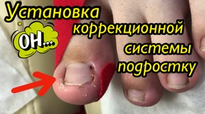 Установка коррекционной системы подростку??⚠️?❗️