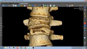 КОМПРЕССИОННЫЙ  ПЕРЕЛОМ  Л2  ПОЗВОНКА