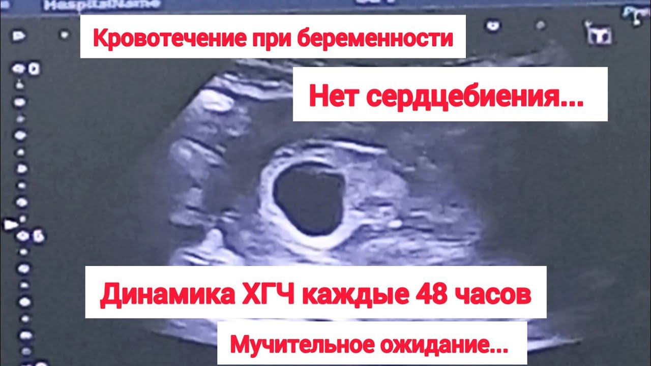 КРОВОТЕЧЕНИЕУГРОЗА ВЫКИДЫШАНЕТ СЕРДЦЕБИЕНИЯ ❤ДИНАМИКА ХГЧ
